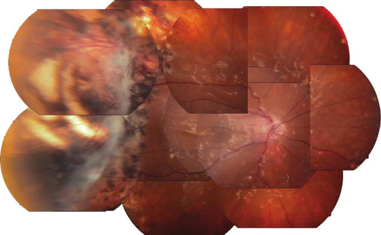 Pacientka č. 3 – Složený snímek očního pozadí za 2,5 roku po ARN, oko po PPV (listopad 2011)