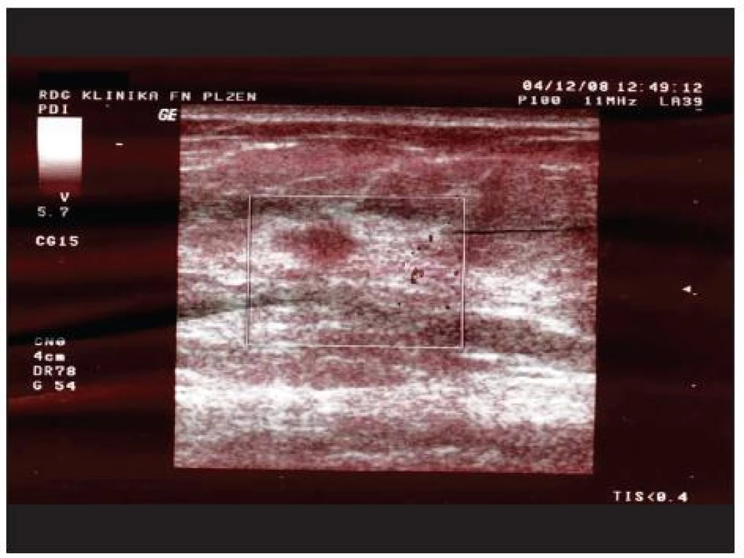 Sonografie pravého prsu – podezřelé ložisko v HZK
Fig. 3. Sonography of the right breast – suspicious focus in the upper outer quadrant