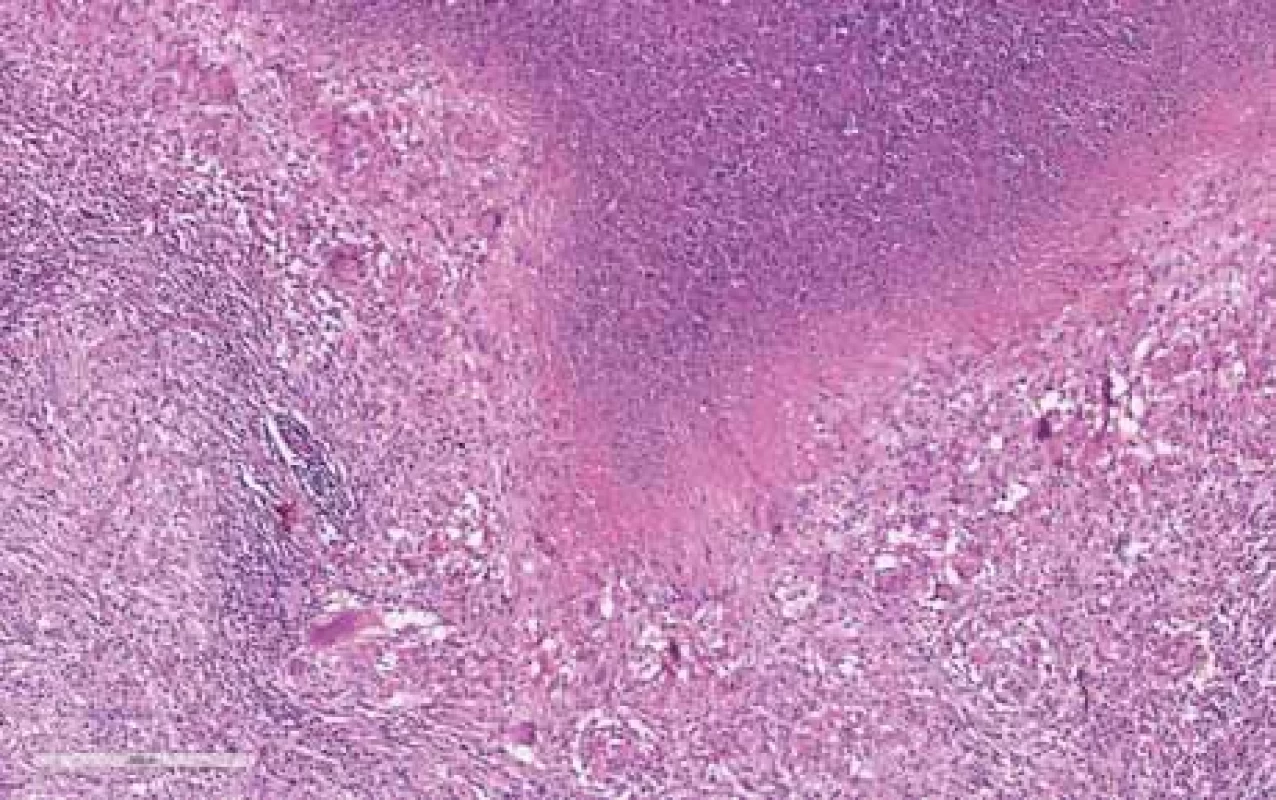 Lymfatická uzlina s nekrózou uvnitř, kde jsou patrny rozpadlé neutrofily a vícejaderné buňky (hematoxylin-eozin, původní zvětšení 10×).