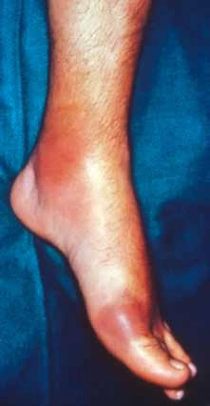 Akutní dnavá artritida prvního metatarzofalangeálního kloubu nohy (podagra).