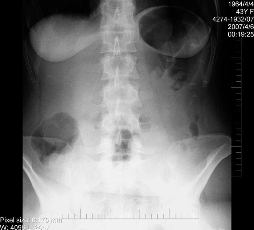 Prostý snímek pacientky při přijetí
Fig 1: Native X-ray taken during the patient’s admission