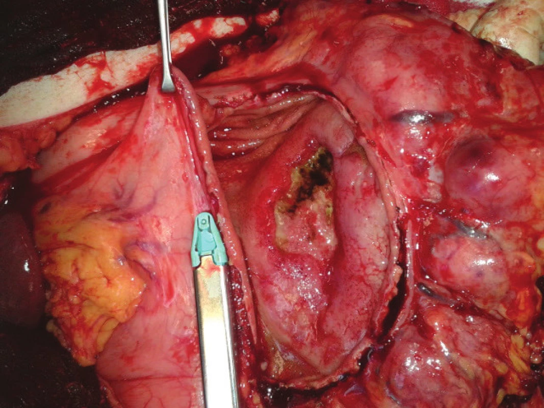 Staplerová sleeve resekce velké křiviny žaludku s objemnou vředovou lézí lymfomu intragastricky
Fig. 3: Linear stapler sleeve resection of the greater curvature with a large ulcerated gastric lymphoma