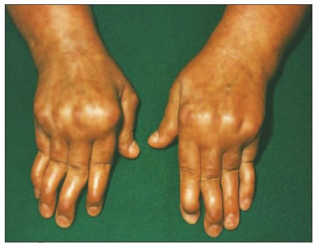 Šľachové deformity u pacienta s SLE (Jaccoudova artropatia).