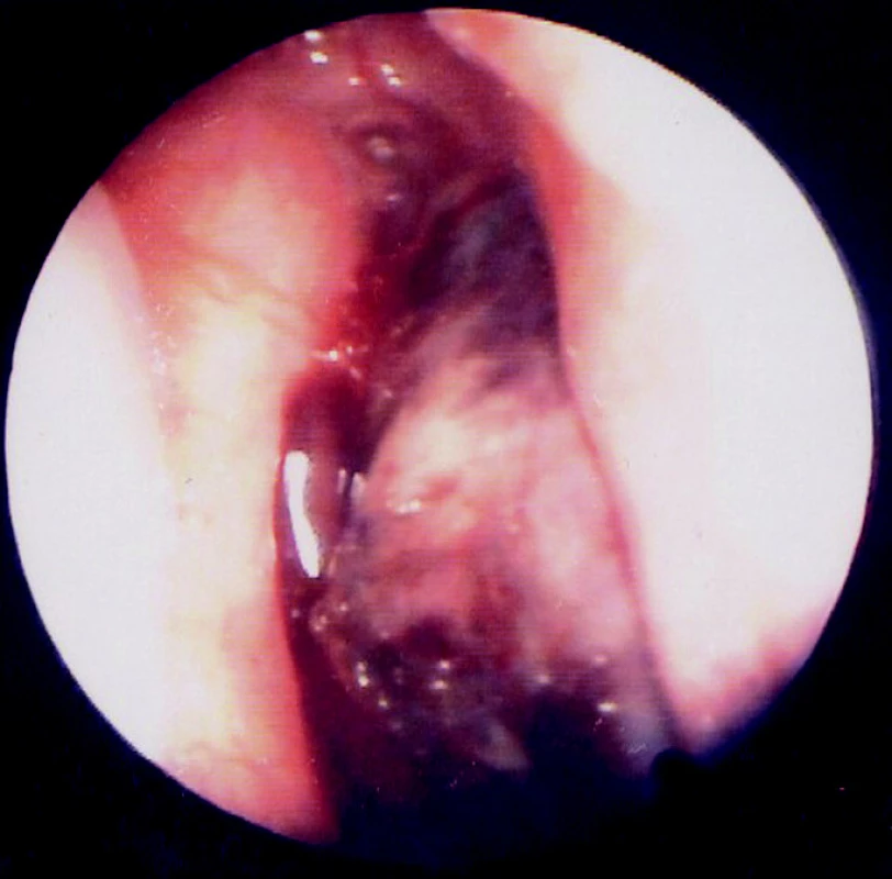 Endoskopický pohled do dutiny nosní zprava
