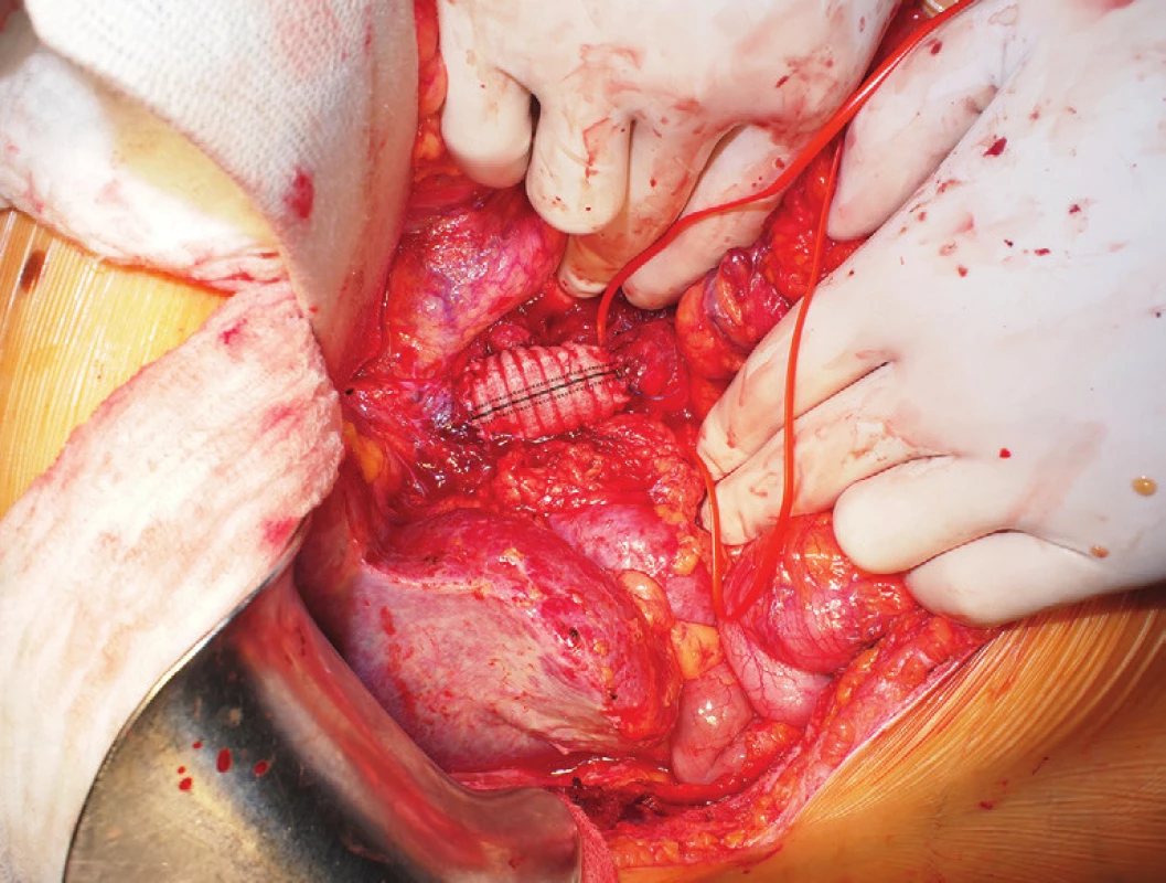 Stav po náhradě defektu ve v. cava inf. protézou
Fig. 7: The anterior wall of inferior caval vein substituted with a vascular prosthesis