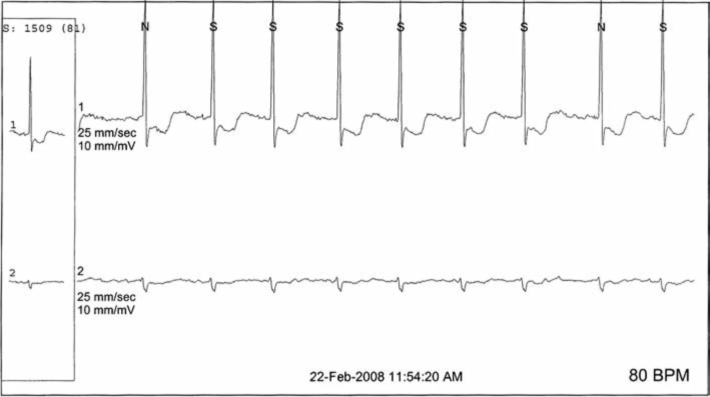 Signifikantná ischémia myokardu aj s fibriláciou z EKG Holter nálezu zo súboru