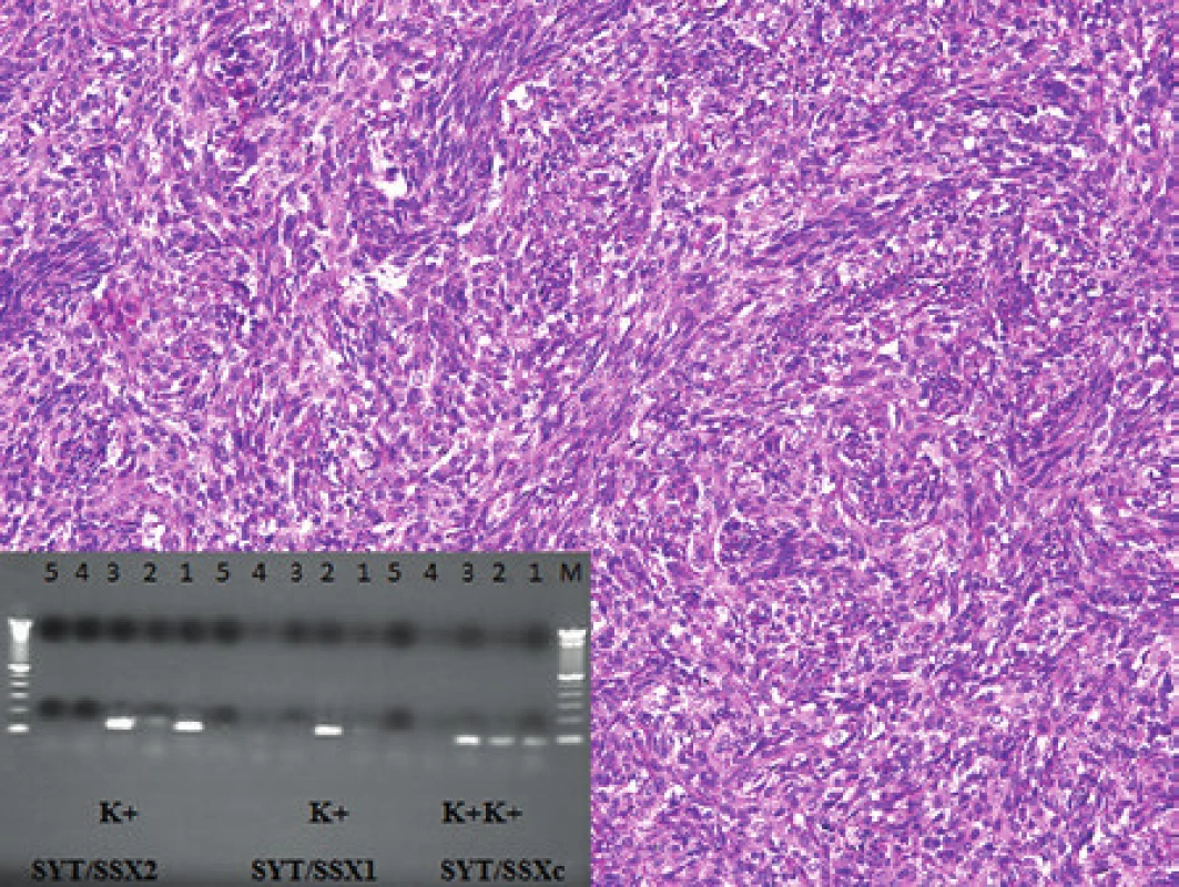 Kazuistika 8. Synoviální sarkom dolní duté žíly a pravé srdeční síně. Barveno hematoxylinem a eozinem (původní zvětšení 100x). Vložený obrázek: Agarózový gel s detekcí fúzního genu SS18/SSX2, který je produktem translokace t(X;18) u pacienta se synoviálním sarkomem. Zprava: 100 bp velikostní marker, 1. SS18/ SSX consensus PCR produkt pacienta, 2. SS18/SSX consensus pozitivní kontrola RT-PCR, 3. SS18/SSX consensus pozitivní kontrola RT-PCR, 4. negativní kontrola RT, 5. negativní kontrola PCR, 1. negativní SS18/SSX1 PCR produkt pacienta, 2. SS18/SSX1 pozitivní kontrola RT-PCR, 3. SS18/SSX2 kontrola RT-PCR, 4. negativní kontrola RT, 5. negativní kontrola PCR 1. SS18/SSX2 pozitivní PCR produkt pacienta, 2. SS18/SSX1 kontrola RT-PCR, 3. SS18/SSX2 pozitivní kontrola RT-PCR, 4. negativní kontrola RT, 5. negativní kontrola PCR.