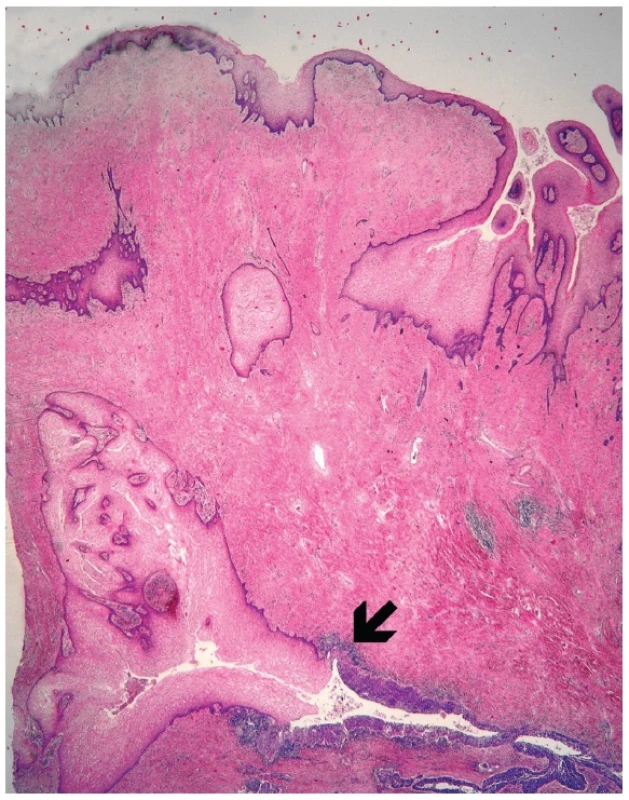 Invagination of the surface epithelium forming a squamous inclusion cyst (H&amp;E, original magnification 20x). Arrow indicates transition between normal and dysplastic squamous  epithelium.