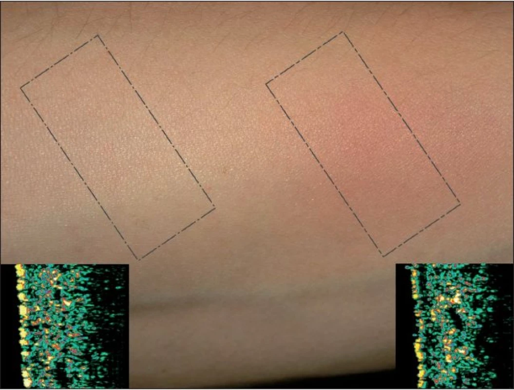 Rozdíl sonografického snímku zdravé kůže (obr. 14a) proti traumatickému hematomu (obr. 14b)