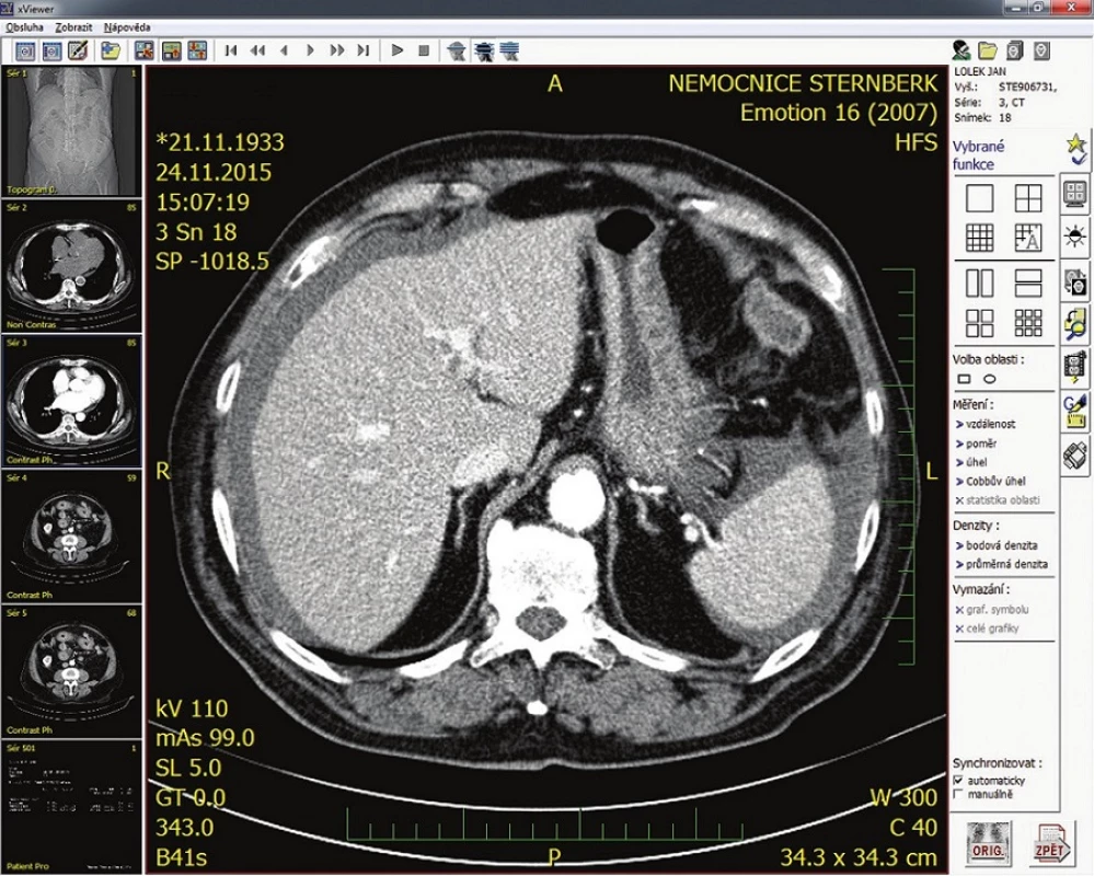 CT s infiltrovanou kličkou tenkého střeva
Fig. 1: CT with infiltrated small intestine