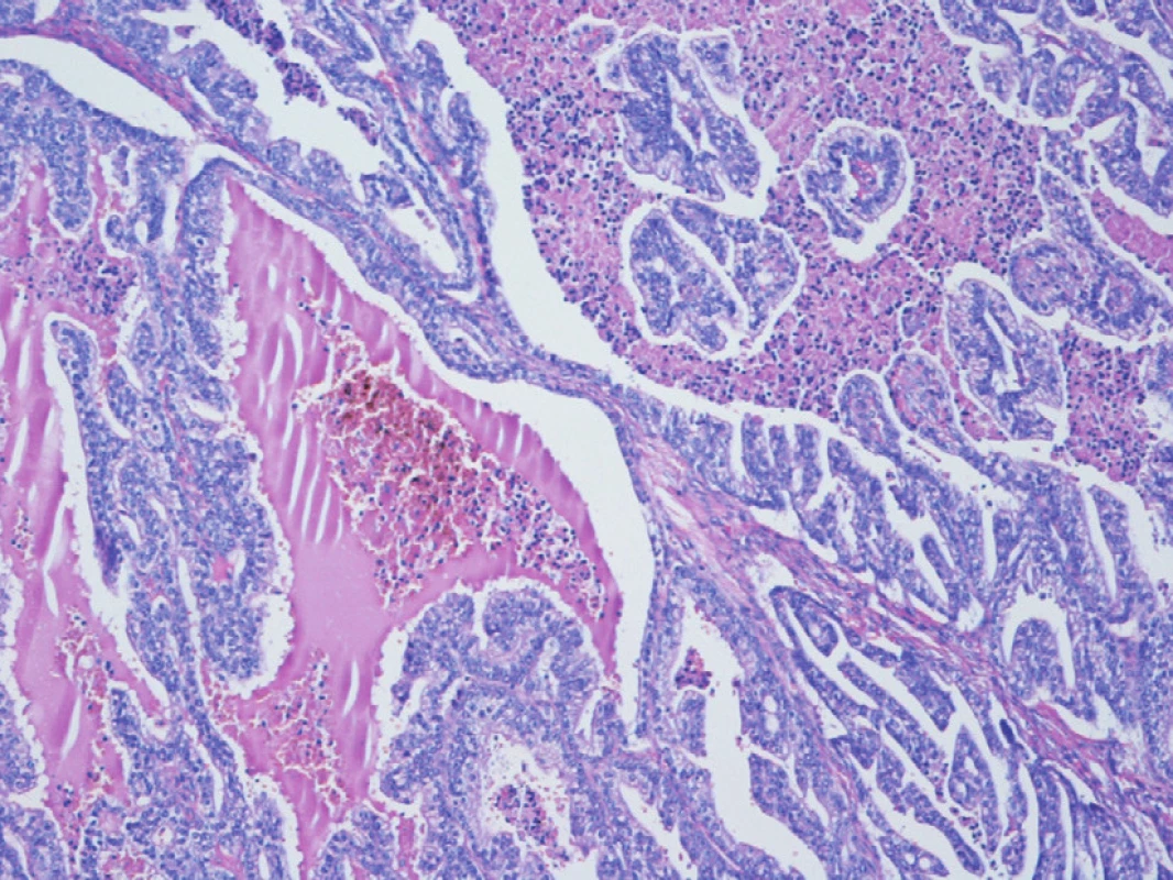 Metastáza karcinomu prostaty do nadvarlete – cystopapilární duktální struktura v základním barvení HE (zvětšeno 100x)
Fig. 1. Epididymal metastatis of prostate cancer – cystopapillary structure in hematoxyline-eosine (zoom 100x)