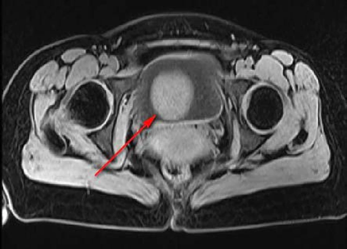 MR, axiální řez, T1 vážený obraz: homogenní, ohraničený, hladký, kulovitý útvar 
v močovém měchýři
Fig. 2. MR scan, axiall section, T1 weighted image: homogenous, smoothly marginated mass in the urinary bladder