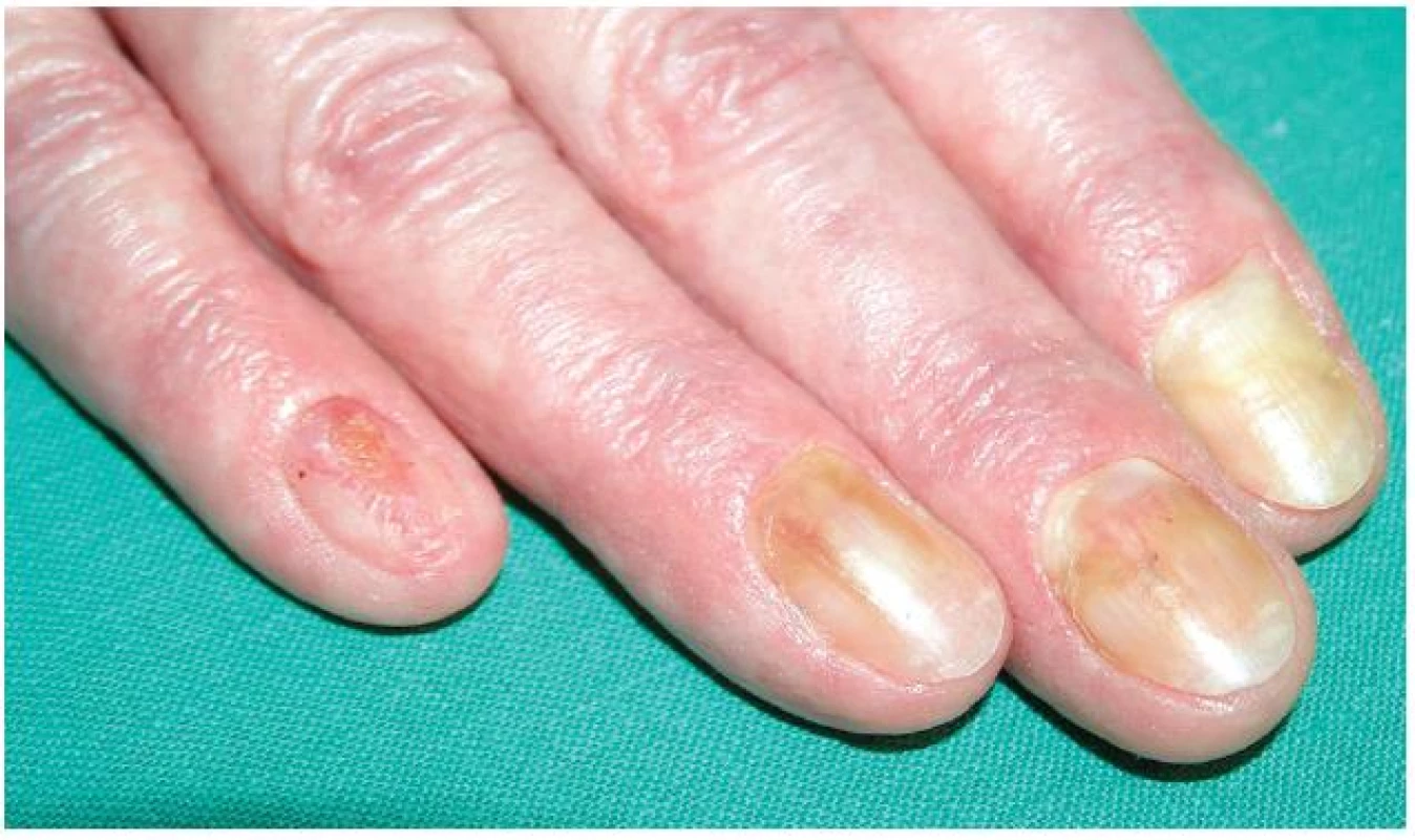 Onycholysis a onychomadesis (na 5. prstu) při Lyellově syndromu po piroxikamu