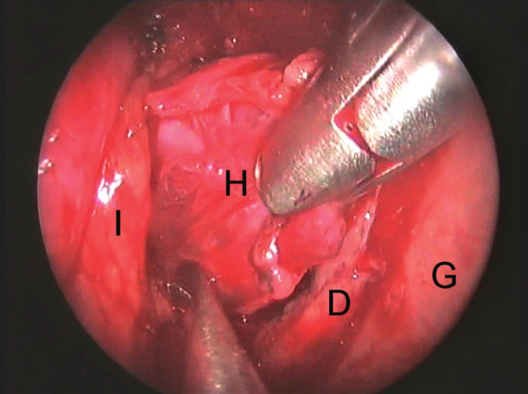 Endoskopický pohled, 4 mm 30° endoskop, pravá nosní dutina 1a, 1b – sinonazální fáze, 1c, 1d- orbitální fáze A-lamina papyracea, Bčelistní dutina C-otevřené čichové sklípky D-horní skořepa E-periorbita F-odstraněná kost lamina papyracea G-nosní septum H-tumor I-orbitální tuk