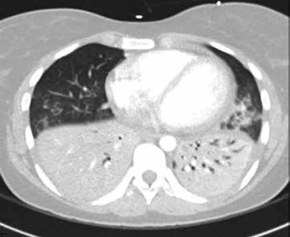 CT vyšetření: oboustranné plicní infiltráty s negativním bronchogramem u pacientky s oboustrannou komunitní pneumonií