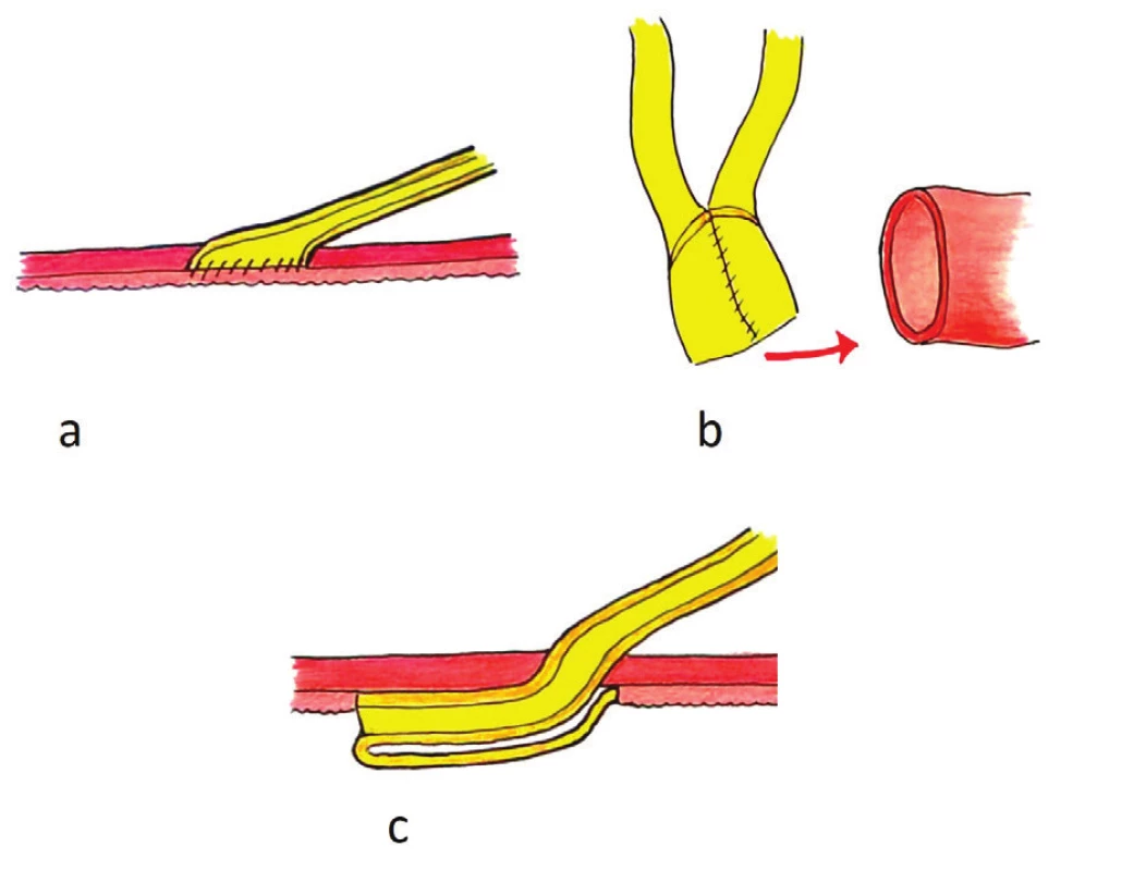 Ureterointestinální anastomózy: a) přímá eliptická anastomóza dle Nesbita, b) anastomóza dle Wallaceho, typ 1 (head-to-head), c) antirefluxní anastomóza „flap-and-trough“ dle Doležela
Fig. 1: Uretero-intestinal anastomoses: a) Nesbit, b) Wallace, c) I Flap-and-Trough