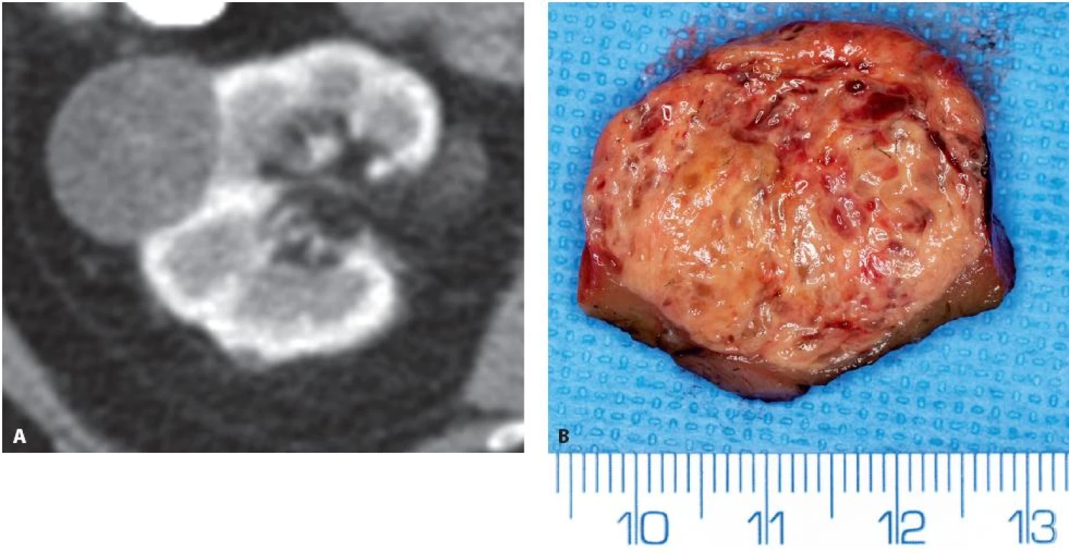 Translokační RK Xp11.2 ASPL-TFE3 na konvexitě prvé ledviny T1bN0M0 u 75leté ženy. A – CT ve venózní fázi, poměrně homogenní tumor s denzitou kolem 70 HU, B – preparát resekátu
Fig. 3. Translocation RCC Xp11.2 ASPL-TFE3 on the convexity of the right kidney T1bN0M0 in 75-year-old woman. A – CT in venous phase, relatively homogenous tumour with a density of about 70 HU, B – specimen at the time of surgery.