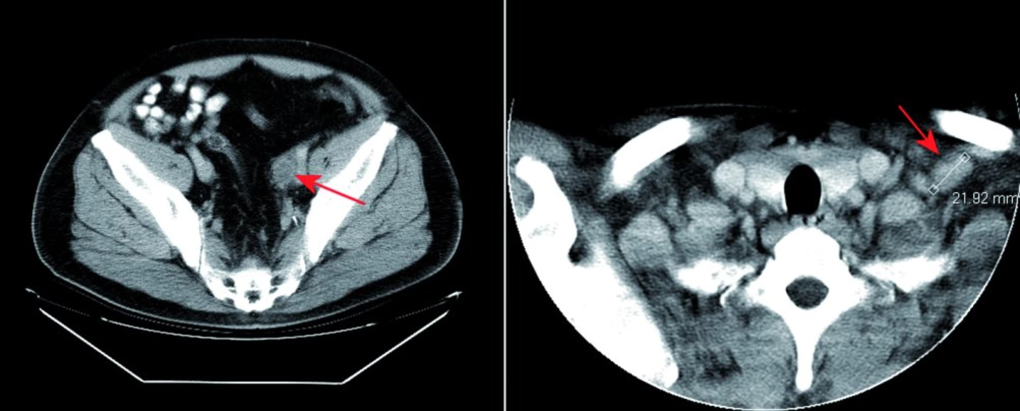 Vstupní CT vyšetření. Na obrázku vlevo CT vyšetření zobrazuje v pánvi vlevo podél cévního svazku patologický uzlinový infiltrát (červená šipka). Na obrázku vpravo jsou při CT vyšetření krku zachyceny tři viditelné zvětšené lymfatické uzliny patologické vizáže v oblasti levé klíční kosti (červená šipka).