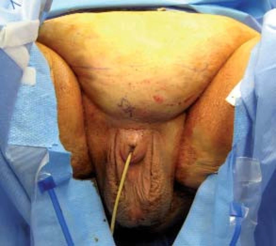 Předoperační vyznačení míst resekce na pacientovi v poloze ve stoje, neboť tyto body ani tukový polštář, který bude odstraněn, nejsou v poloze na zádech patrné.