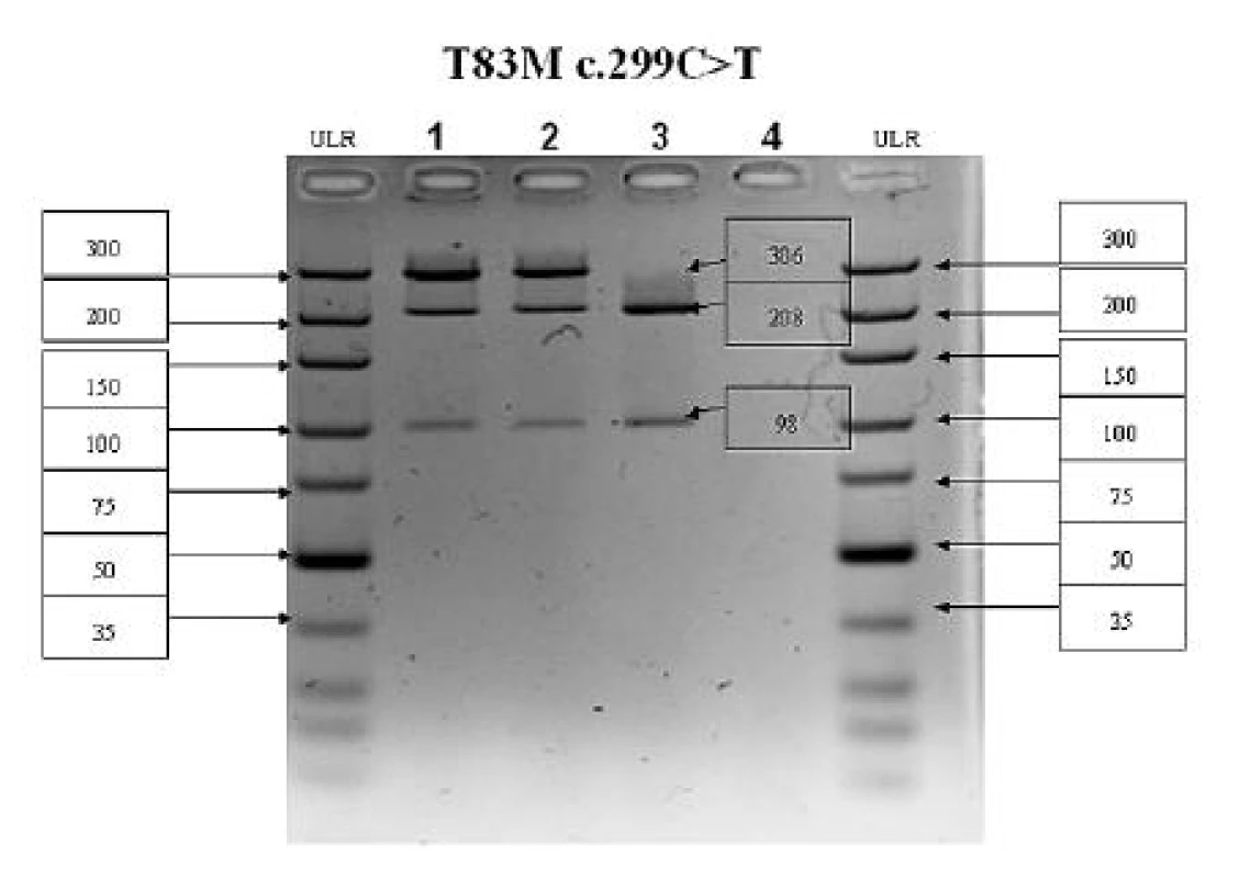 PCR-RFLP analýza 5. exónu ALPL génu 
V prípade mutácie c.299C&gt;T(T83M) zaniká štiepne miesto Hpy-CH4IV. PCR produkt má veľkosť 306 bp, v prípade štandardnej wildtype (WT) alely vznikajú fragmenty 208 a 98 bp, v prípade mutovanej alely (MUT) fragment ostáva neštiepený 306 bp.
Dráha č. 1 – pacientka 1 (WT/MUT), dráha č. 2 – pacientka 2 (WT/MUT), dráha č. 3 – kontrolná vzorka (WT/WT), dráha č. 4 – negatívna kontrola; ULR – marker molekulovej hmotnosti 