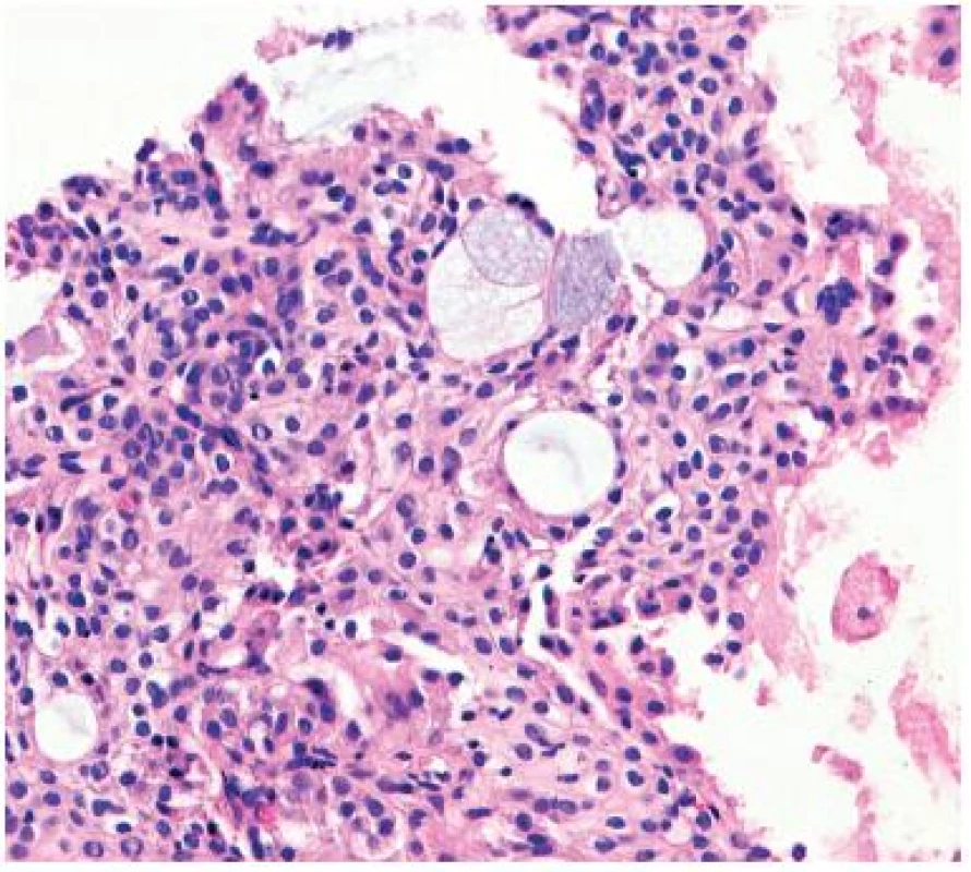 Fragmenty low-grade mukoepidermoidního karcinomu sestávají z epidermoidních a mucinozních buněk. Hematoxylin a eozin, zvětšení 200krát