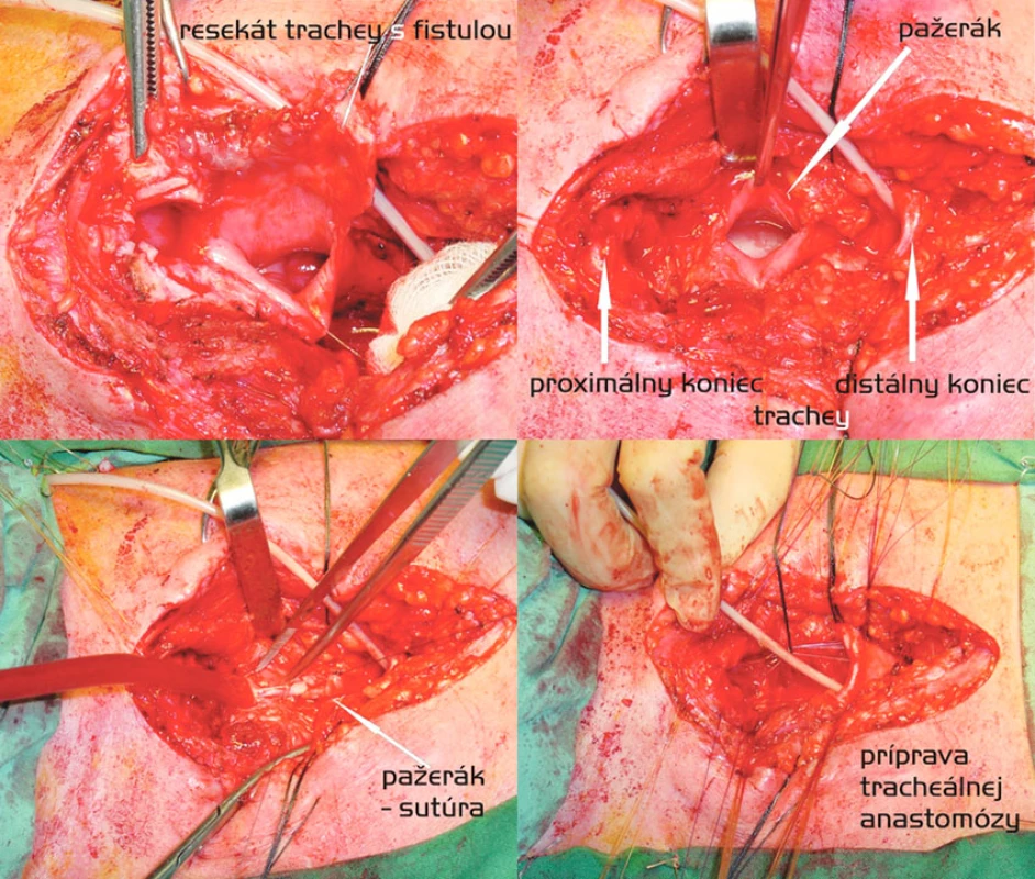 Segmentálna resekcia trachey s anastomózou end-to-end a dvojvrstvová sutúra pažeráka. Postup zľava doprava, zhora nadol
Fig. 2. Segmental tracheal resection with end-to-end anastomosis and a double- layer esophageal suture. Left to right and top to down