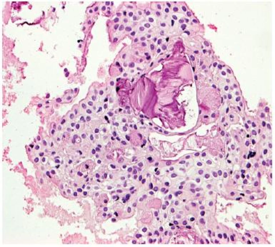 Průkaz intracytoplazmatické hlenotvorby u intraoseálního (centrálního) mukoepidermoidního karcinomu. Mucikarmin, zvětšení 200krát