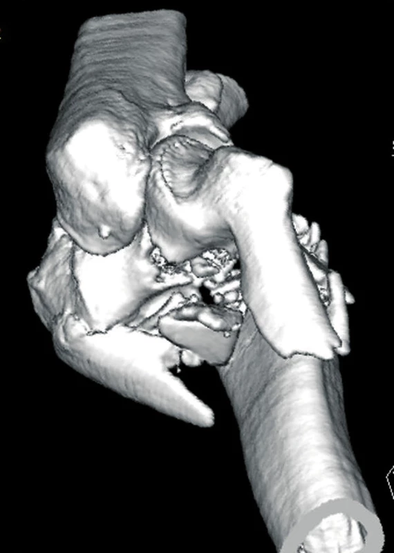 CT vyšetření - 3D rekonstrukce zlomeniny distálního humeru v předozadní projekci
