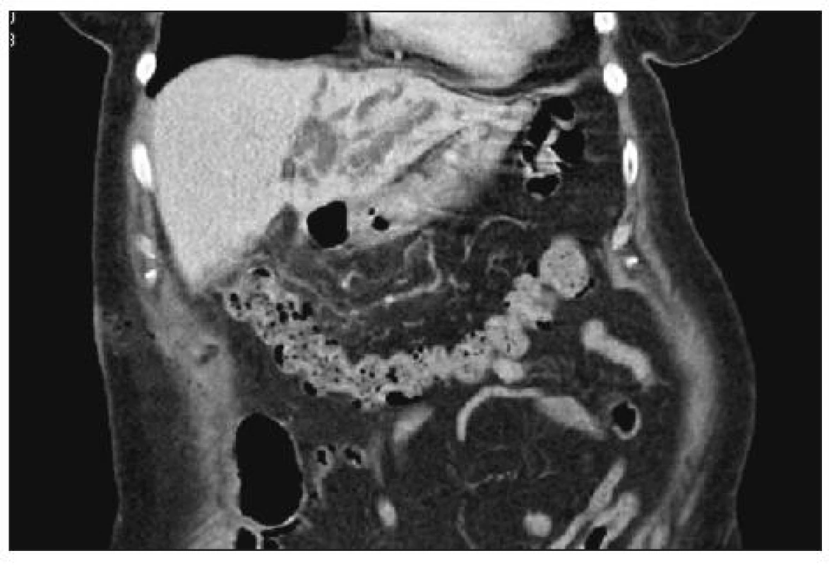 CT obraz dilatace žlučových cest v oblasti 2. a 3. jaterního segmentu
Fig. 5. CT image of bile duct dilatation in area 2&lt;sup&gt;nd&lt;/sup&gt; and 3&lt;sup&gt;rd&lt;/sup&gt; liver segment