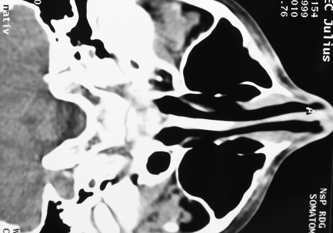 – CT obraz lebky v časovom odstupe 4 mesiace po operačnom výkone.