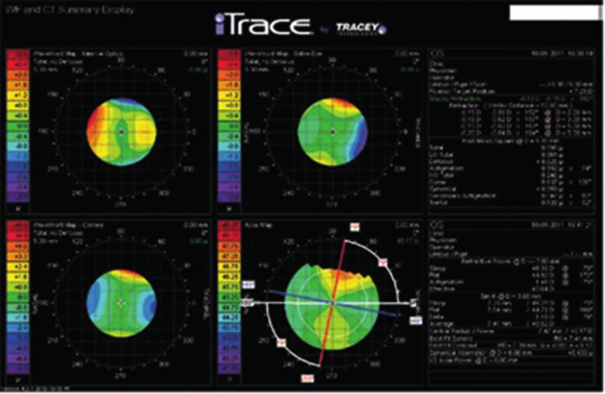 Výchozí zobrazení dat ve 2D, mapa celkové wavefront analýzy (vpravo nahoře), mapa aberací rohovky (vlevo dole) a aberace vnitřní optiky oka (vlevo nahoře)