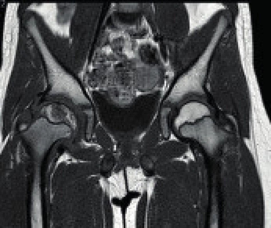 Magnetická rezonance ukazující Perthesovu chorobu pravého kyčelního kloubu.
Fig. 3. MR image showing the affection of the right hip by Perthes disease.