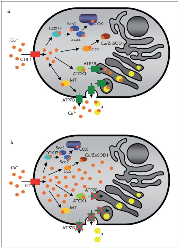 Schéma transportu mědi v buňce: a) fyziologický stav, b) patologický stav způsobený poruchou proteinu ATP7B při Wilsonově chorobě. 
Cu&lt;sup&gt;+&lt;/sup&gt; – atomy mědi, COX – cytochrom c oxidáza, P – protein (např. ceruloplazmin), MT – metallothionein, Cu/Zn SOD1, Cu/Zn superoxiddismutáza 1, CTR1 – přenašeč mědi, ATP7B – membránová ATP-áza – Wilsonův protein, COX17, Sco1, Sco2, CCS, ATOX1 – metalochaperony [23].