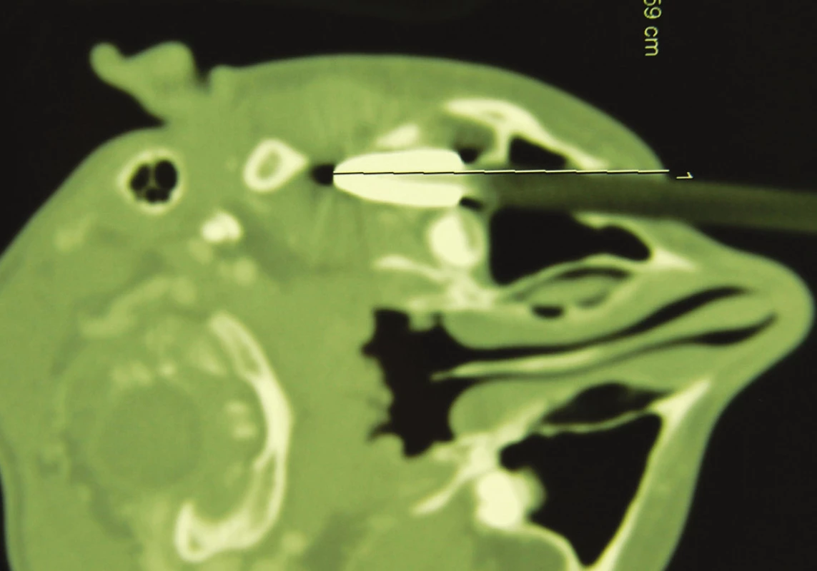 – CT obraz lokalizácie šípu v skelete lebky.