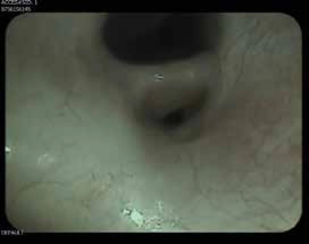 Bronchoskopie: stenóza linguly