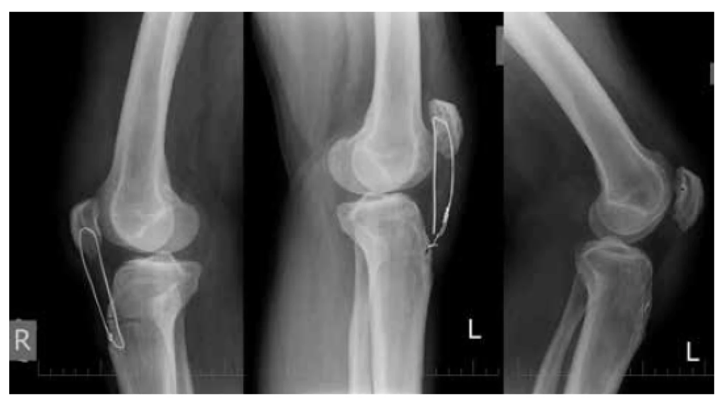 RTG snímky oboch kolien 3 mesiace po operácii
  bilaterálnej ruptúry <i>ligamentum patellae</i>
Roztrhnutie serklážnej slučky vľavo. RTG snímka po extrakcii
serklážnej slučky vľavo. Postavenie patelly obojstranne vyhovuje
(Insall-Salvati ratio=0,96).<br>
Fig. 4: Lateral views of both knees 3 months after bilateral
patellar tendon suture
Broken cerclage wire on the left knee. Correct patellar position
on both knees (Insall-Salvati ratio=0.96).