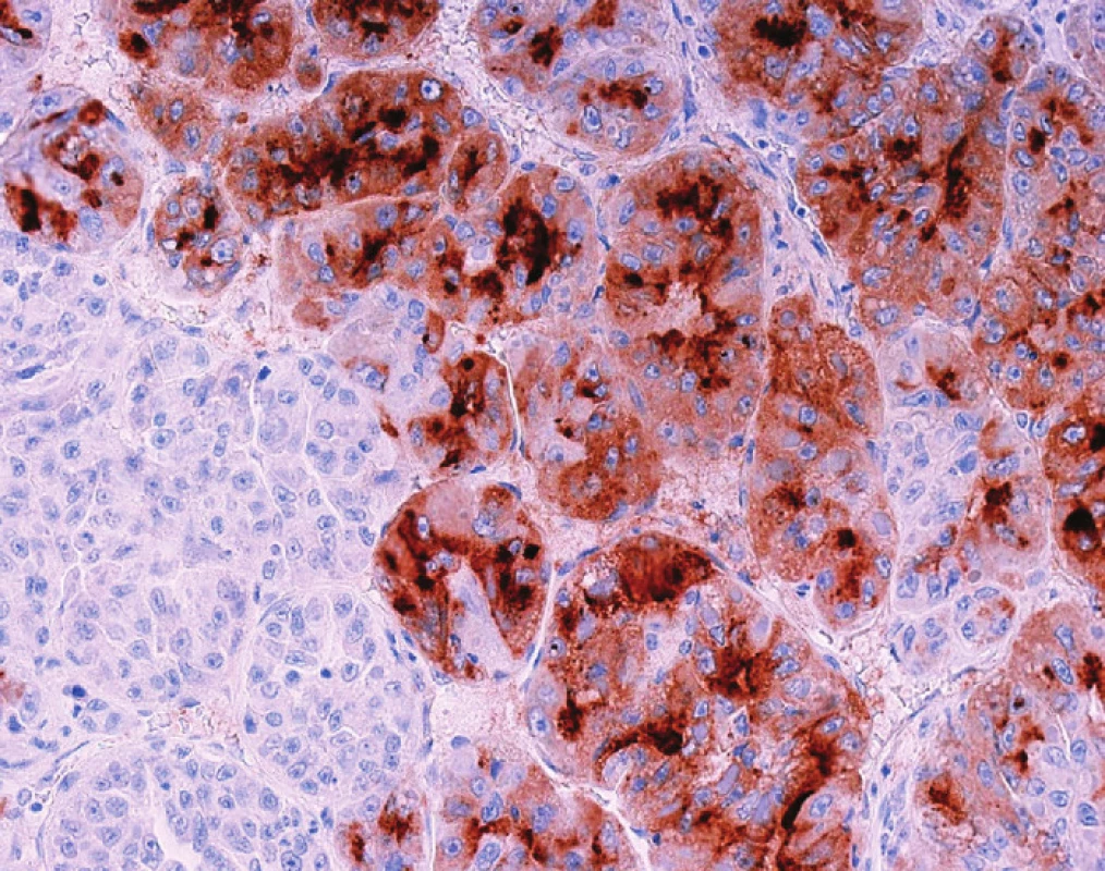 HCC s fokálně pozitivním imunohistochemickým průkazem glypicanu-3 (hnědě) Negativní úseky jsou též HCC, negativní průkaz nevylučuje diagnózu HCC.
Fig. 3: Immunostaining for glypican-3 shows focal expression in the cytoplasm of tumor cells (brown) Negative cells here are also HCC; and negative glypican-3 staining does not rule out the diagnosis of HCC.