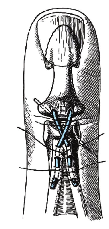 Použitie šľachového transplantátu pri strate šľachy a úplne pasívne mobilnom DIP kĺbe Transplantát má byť 2 mm široký a 6 cm dlhý. Jeho stredná časť sa ukotví do fibrózneho tkaniva na báze distálneho článku. Konce transplantátu sa prekrížia, prevlečú laterálnymi pruhmi extenzorového mechanizmu a fixujú sa niekoľkými stehmi. DIP kĺb sa fixuje Kirschnerovým drôtom v miernej hyperextenzii [2].
Fig. 8: Tendon graft used for a loss of tendon substance with a fully passively mobile DIP joint
Tendon graft should be 2 mm wide and 6 cm long. The middle part of the graft is anchored to the fibrous tissue at the base of the terminal phalanx. The two ends of the graft are crossed over, passed trhough the lateral extensor tendons and fixed with several stiches. DIP joint is fixed with K-wire in slight hyperextension [2].