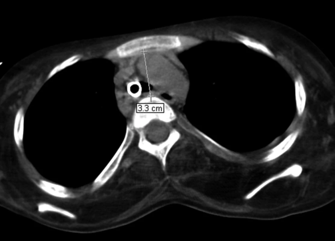 Porovnání ventrodorzální šíře horního mediastina v referenční úrovni aortálního oblouku v červnu 2007 – šíře 33 mm
