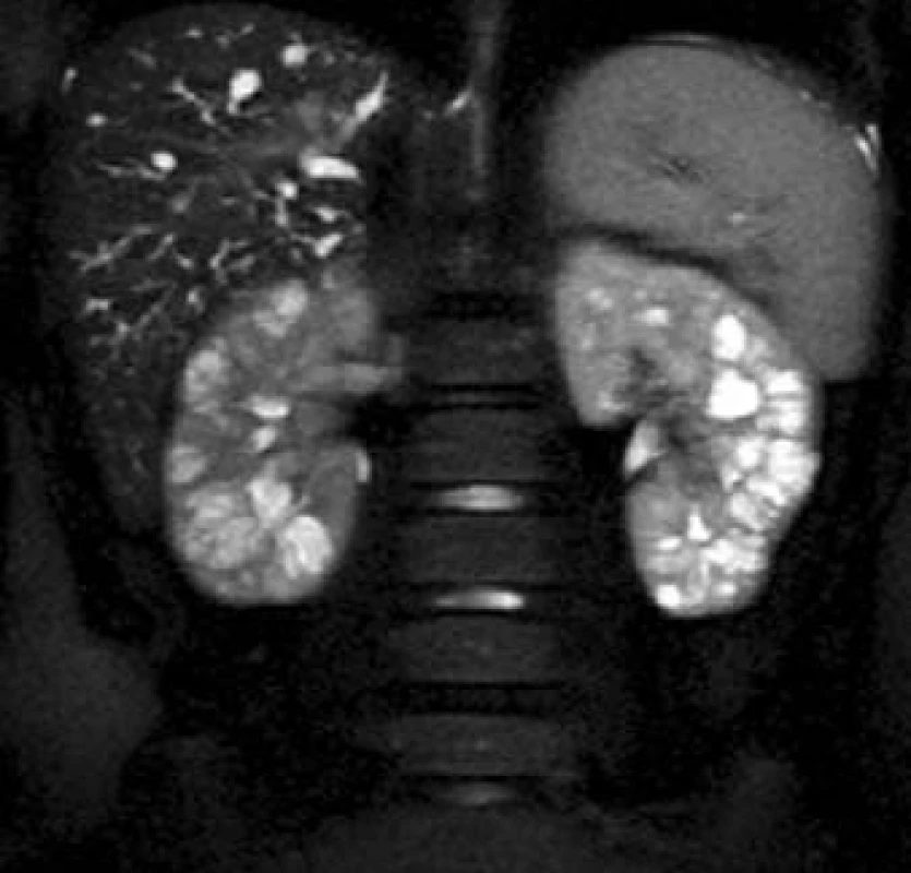 Obraz houbovitých ledvin v koronárním MRI-obraze v T2 vážení se saturací tukové tkáně.