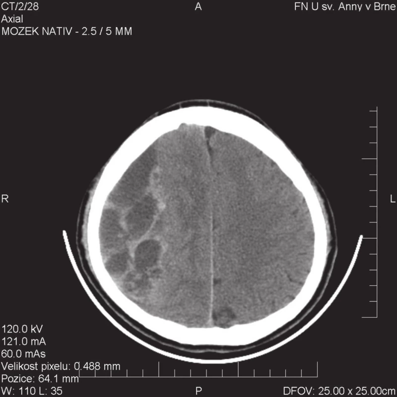CT obraz septovaného CHSDH s minimem tekuté složky, nutné řešit primární kraniotomií
Fig. 2: CT image of septated CHSDH with minimum fluid component, primary craniotomy needed