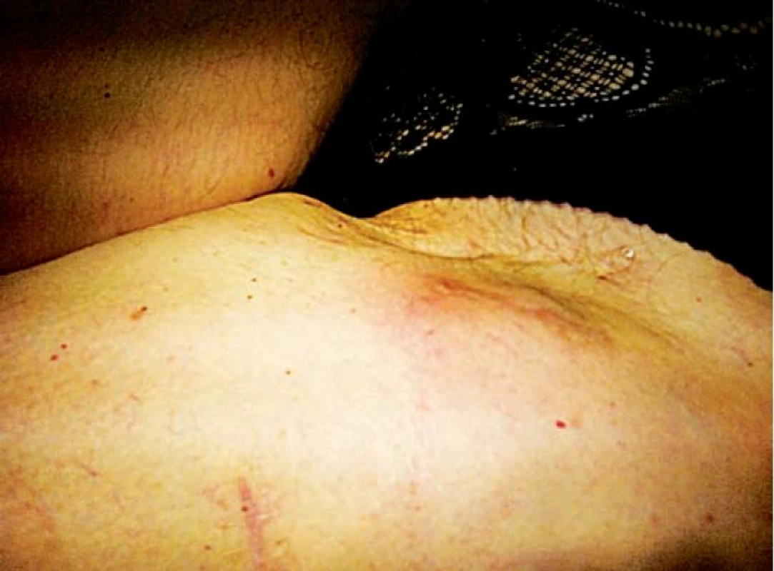 Podkožní noduly – kožní metastázy na levém stehně pacientky