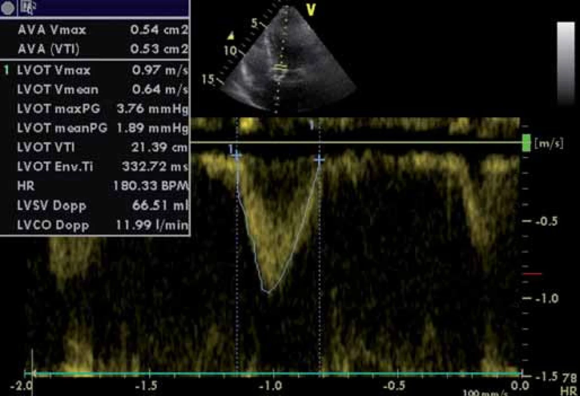 Parametry LVOT – pulzní dopplerovské vyšetření. Výpočet AVA (viz i předchozí obrázky) pomocí rovnice kontinuity.