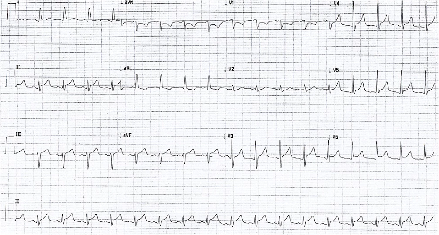 Electrocardiogram showing widespread ST elevation