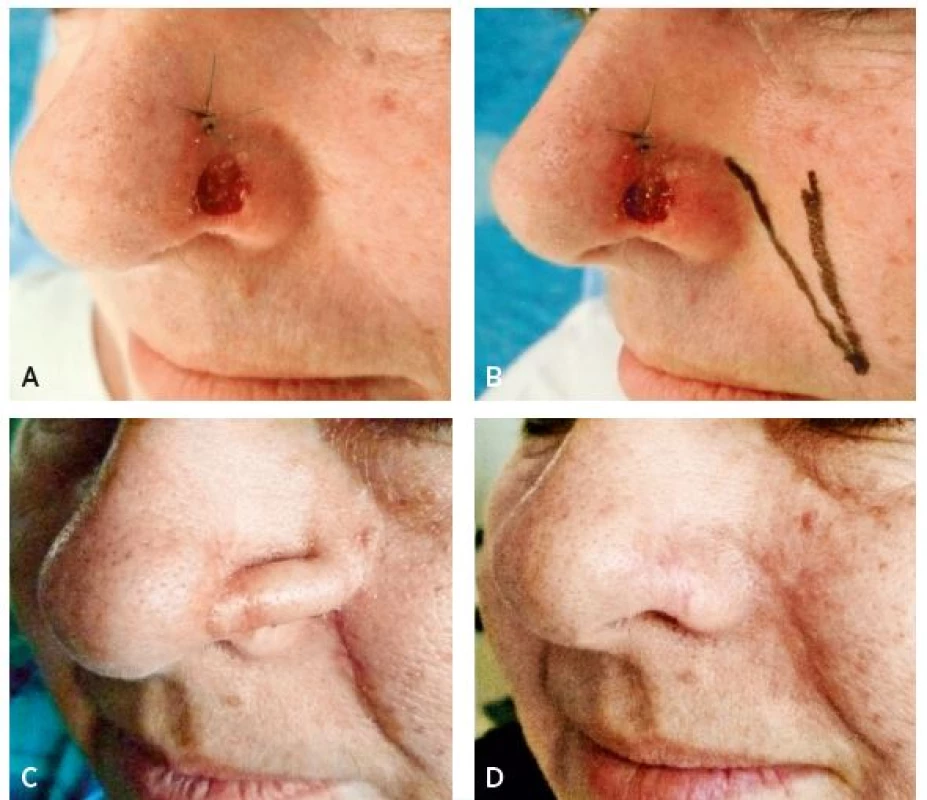 A–D. Sequence of nasal ala defect reconstruction with interpolation nasolabial flap