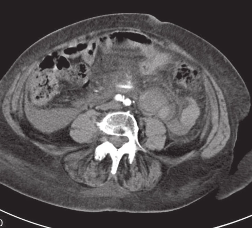 CT vyšetření v axiální rovině potvrzující krvácení v blízkosti horní mezenterické tepny
Fig. 3: Axial reconstruction of CT images confirming bleeding near the superior mesenteric artery