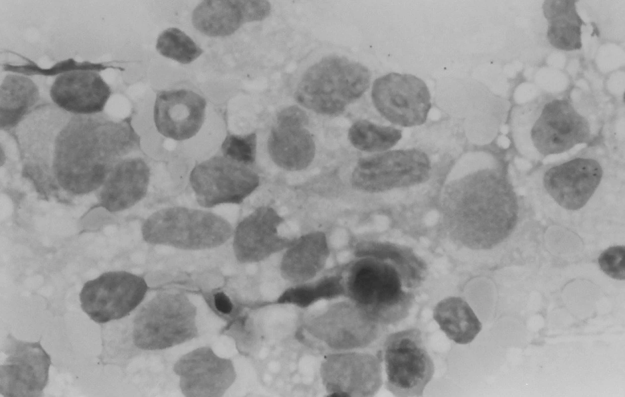 Punkcia kostnej drene: zmnožené makrofágy a monocyty.
Fig. 5. Puncture of bone marrow: multiplied macrophages and monocytes.