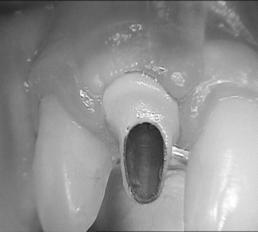 Titanokeramická nadstavba fixovaná centrálnou skrutkou na implantáte. (Foto: Eurodent medima, s.r.o.)