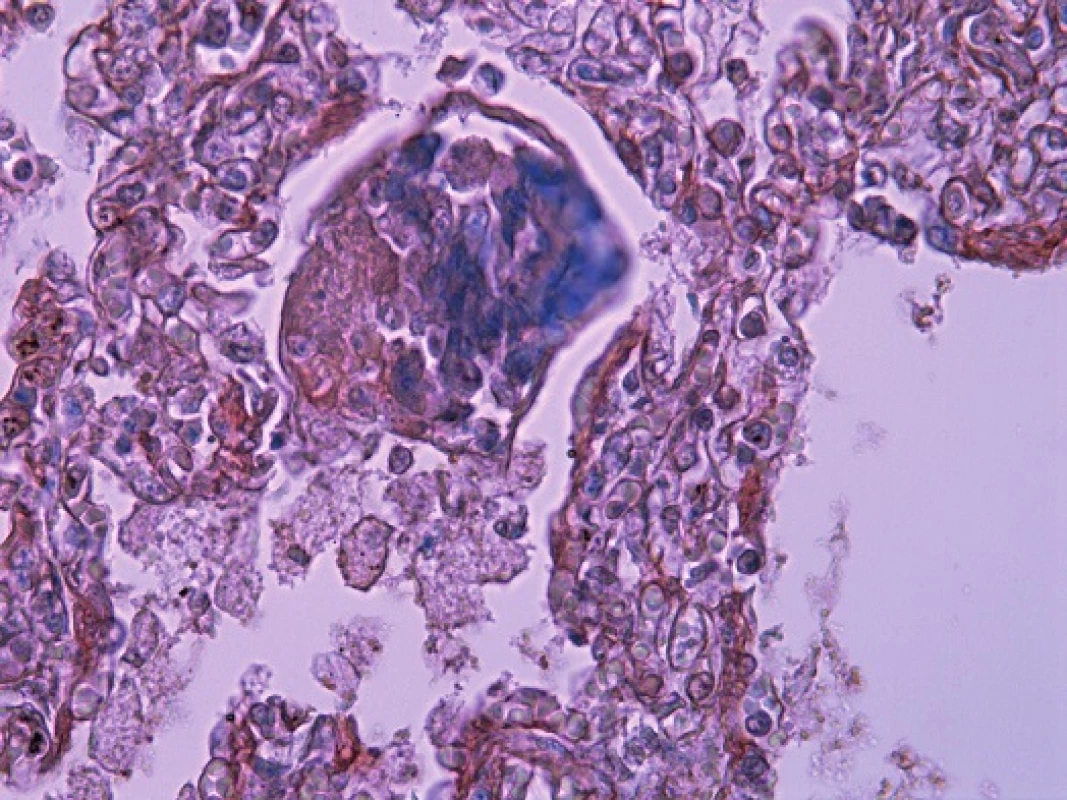 Zvyšky fibrínovej exsudácie v pľúcnom „hassalloidnom“ teliesku v alveole (PTAH, 240x).