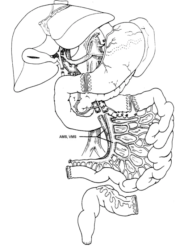Schéma odběru štěpu tenkého střeva
Pic. 1. The small intestine graft collection – A scheme
AMS, VMS – a., v. mesenteria superior